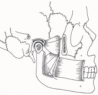 Pterygoideus lateralis tulee näkyviin, kun osa leukaluuta ja poskiluuta leikataan pois. Kuvassa kyseinen lihas sijoittuu ylimmäksi. Tämän lihaksen ärsyyntyminen saattaa johtaa poskikivun ja -säryn lisäksi tunteeseen siitä kuin purennassa hampaat eivät aivan osuisi kohdilleen eikä lääketieteellisesti selittämätön korvakipukaan ole mahdotonta.