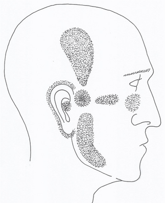 Oheisessa piirroksessa tyypillisiä leukanivelperäisiä oirealueita. Bruxaamisessa oireilu on usein laaja-alaisempaa ja vaikeammin paikannettavaa pään ja kasvojen alueella.