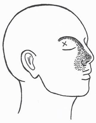 Orbicularis oculi lihas saattaa heijastaa kipua ja särkyä nenän sivustaan monenlaisten muiden oireiden lisäksi..